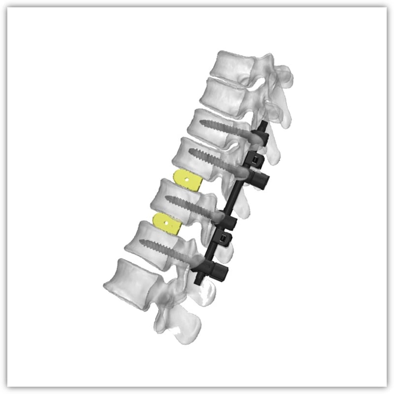 CareFix Posterior Spinal Internal Fixation System — Polyaxial Pedicle Screws and Rods